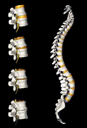 Osteoarthritis of the spine